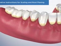 Post-Operative Instructions for Scaling and Root P