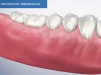 Prophy vs Periodontal Maintenance