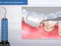 Site-Specific Antibiotic Placement