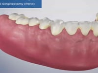 Traditional Gingivectomy (Perio)