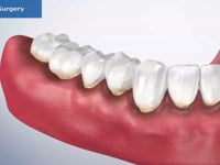 Osseous Surgery