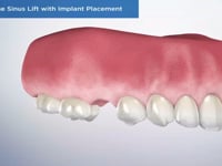 Osteotome Sinus Lift with Implant Placement