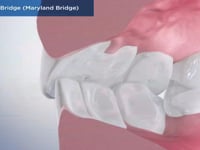 Adhesive Bridge (Maryland Bridge)