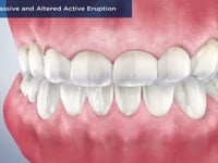 Altered Passive and Altered Active Eruption