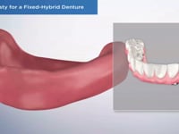 Alveoplasty for a Fixed-Hybrid Denture