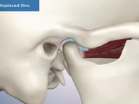 Anterior Displaced Disc