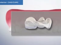 Bridge (Anterior- CADCAM)
