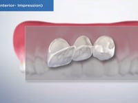 Bridge (Anterior- Impression)