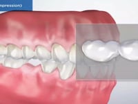 Bridge Versus an Implant