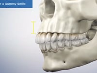 Causes for a Gummy Smile
