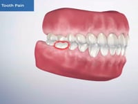 Causes of Tooth Pain