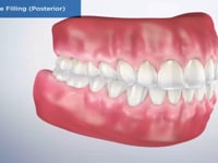 Composite Filling (Posterior)