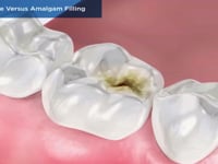 Composite Versus Amalgam Filling