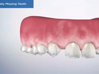 Congenitally Missing Teeth