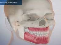 Consequences of Bone Loss