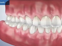 Cracked Tooth