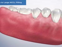 Crack Due to Large NCCL Filling