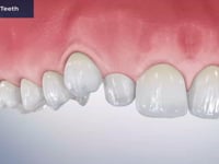 Crowded Teeth