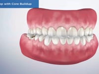 Crown Prep with Core Buildup