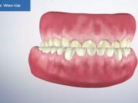 Diagnostic Wax-Up