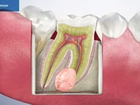 Dental Tumor