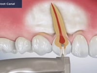 Elective Root Canal