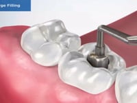 Failed Large Fillings (Amalgam)