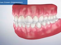 Filling Versus Crown (Impression)