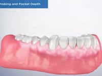 Gingival Probing and Pocket Depth