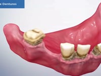 Immediate Denture