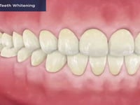 In-Office Teeth Whitening