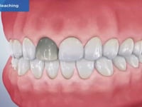 Internal Bleaching