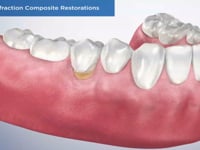 NCCL Abfraction Composite Restorations