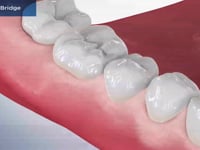 Posterior Bridge