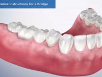 Post-Operative Instructions for a Bridge
