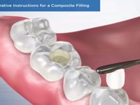 Post-Operative Instructions for a Composite Fillin