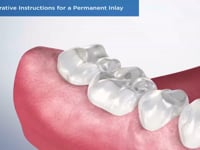 Post-Operative Instructions for a Permanent Inlay