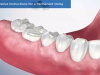 Post-Operative Instructions for a Permanent Onlay
