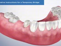 Post-Operative Instructions for a Temporary Bridge