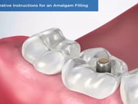 Post-Operative Instructions for an Amalgam Filling