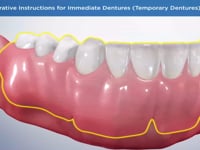 Post-Operative Instructions for Immediate Dentures