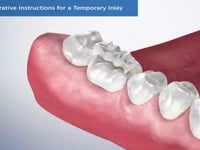 Post-Operative Instructions for a Temporary Inlay