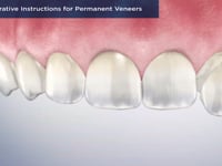 Post-Operative Instructions for Permanent Veneers