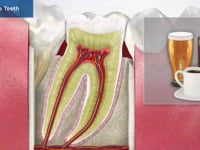 Sensitive Teeth