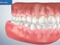 Single Tooth Loss