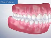 Amalgam Filling (Posterior)