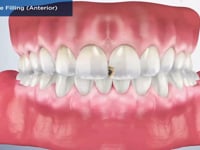 Composite Filling (Anterior)