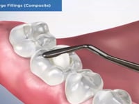 Failed Large Fillings (Composite)