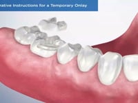 Post-Operative Instructions for a Temporary Onlay