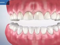 Dental Erosion